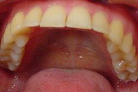 【矯正症例】ディープバイト、睡眠時無呼吸症候群が疑われた症例